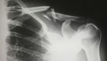 Do we need radiotherapy following surgery for pathological fractures on metastatic bone cancer patients?